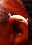Ohr-Keloid